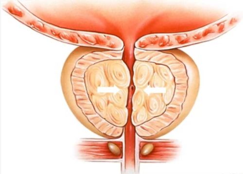 Embolisation de l’adénome de prostate: résultats sur la sexualité, et effets indésirables